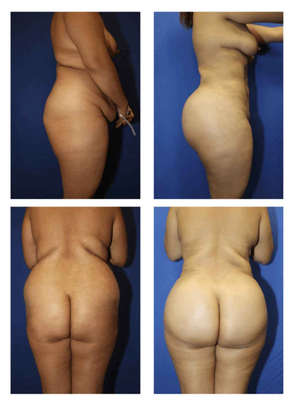 fat transfer before and after